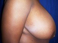 A patient shows her right breast before having breast surgery