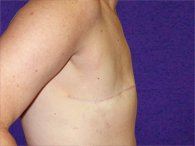 A patient in the right view of her flat chest before the procedure