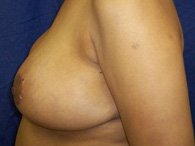 A patient of perimeter plastic surgery before her breast and arm surgery.