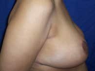 A left view of a patient woman's left breast after the surgery.