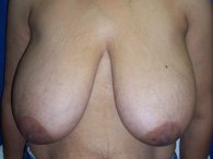 A patient's front view of her breasts before the surgery