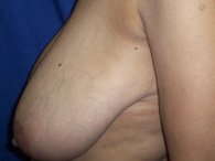 A patient's left breast before having breast surgery