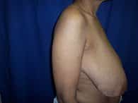 A patient in the right view of the excess skin of her breast and arm before the surgery