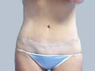 Tummy tuck post-surgery of a patient in a sky-blue bikini