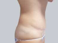 A patient woman on the right side of her flat tummy after the surgery