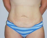 A patient wearing a striped blue undergarment showing her abdomen in front angle before the surgery.