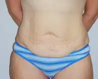 A patient wearing a striped blue undergarment showing her abdomen in front angle before the surgery.