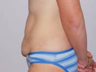 A patient's left view of her lower abdomen before the surgery