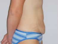 A patient's excess skin on her tummy is visible in the right-side view before surgery.