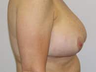 A right-angle of a patient's breast and arm after the surgery.