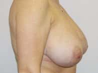 The right side of a patient's breasts before the surgery