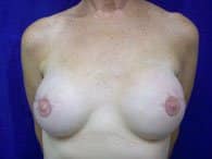 A frontal view of a patient's breasts after breast surgery