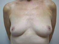 Frontal view of a patient prior to breast surgery