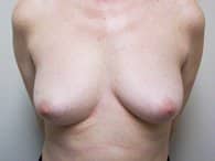 A patient's front angle of her breasts.