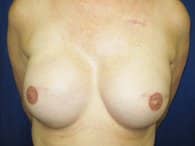 A patient's frontal view of her breasts