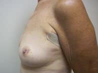 In a left view, a patient shows her breast and arm before the surgery