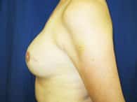 In a left view, a patient displays her breast and arm