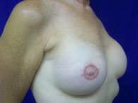 A patient's angle of her breast after breast reconstruction surgery.