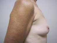 A woman's right-angle of her breast and arm before undergoing plastic surgery at Perimeter Plastic Surgery in Atlanta.