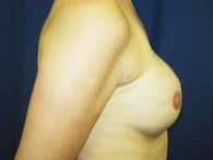 A patient's left-sided view of her breast.