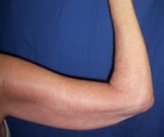 A patient's right arm after surgery.
