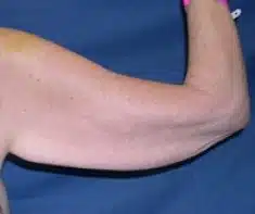 A patient's right arm before undergoing arm lift surgery.