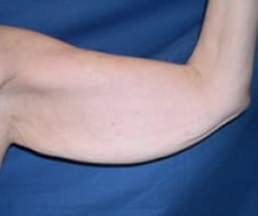 The left arm of the patient before the surgery.