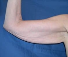 A patient's right arm before arm lift surgery