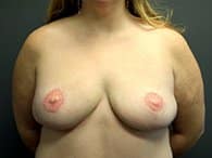 A patient woman in front view showed the results of her chest after the surgery.