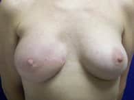 A patient's center angle of her successful breast surgery.