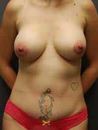 A patient in a front view of her breasts, tummy, and arms after the surgery