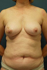 A front view of a woman in skin tone underwear showing her breasts and abdomen before mommy makeover.