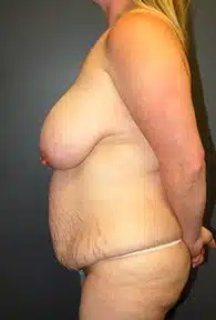 A patient's left view of the body before her mommy makeover procedure shows only the breast, abdomen and arm.