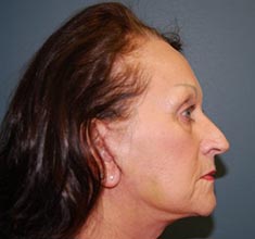 A patient woman's right side of her face after the face lift surgery