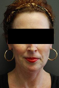 A woman's front view of her neck, covering her eyes and wearing big earrings, after neck lift surgery