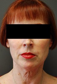 A front face of a patient before a neck lift procedure