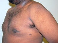A patient in left view of her chest and arm after the surgical procedure