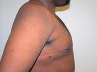 A patient's right side of his chest and arm after the Gynecomastia surgery.