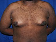 Front view of patient's breasts, abdomen and arms before the surgery