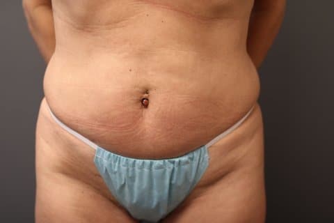 A patient's front view of her abdomen before undergoing mini tummy tuck surgery