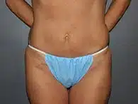 mini tummy tuck before and after