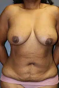 A patient woman in a front view of her breasts, tummy, and arms, wearing a pink bikini, before mommy makeover procedure