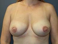 A patient's front view of her breasts after Latissimus flap procedure
