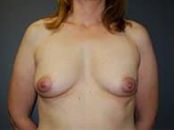 A woman's front view shows her chest before breast reconstruction surgery.