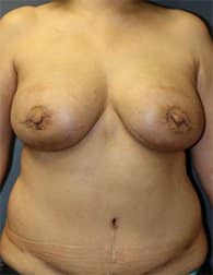 A patient of Perimeter Plastic Surgery in Atlanta shows her results after a TRAM flap breast reconstruction.