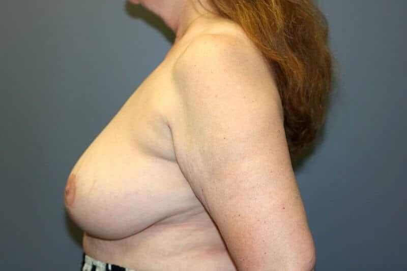 A left-sided view of a patient woman's breast after the surgery.