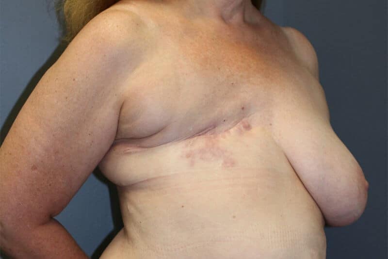 A patient's right-angle angle of her breast before undergoing breast augmentation surgery.