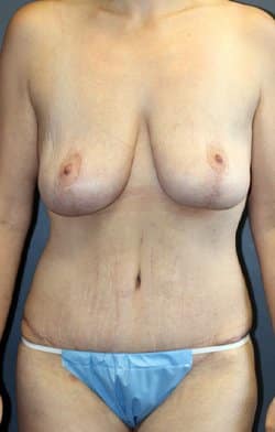 The front view of a patient's post-surgery breasts and tummy.