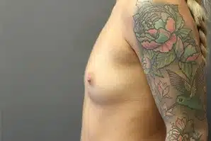 A patient's left breast, abdomen and tattooed arm before surgery.