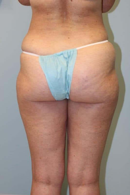 A patient before her butt lift surgery at Perimeter Plastic Surgery